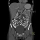 Post-radiation enteritis, enterography, positive contrast: CT - Computed tomography